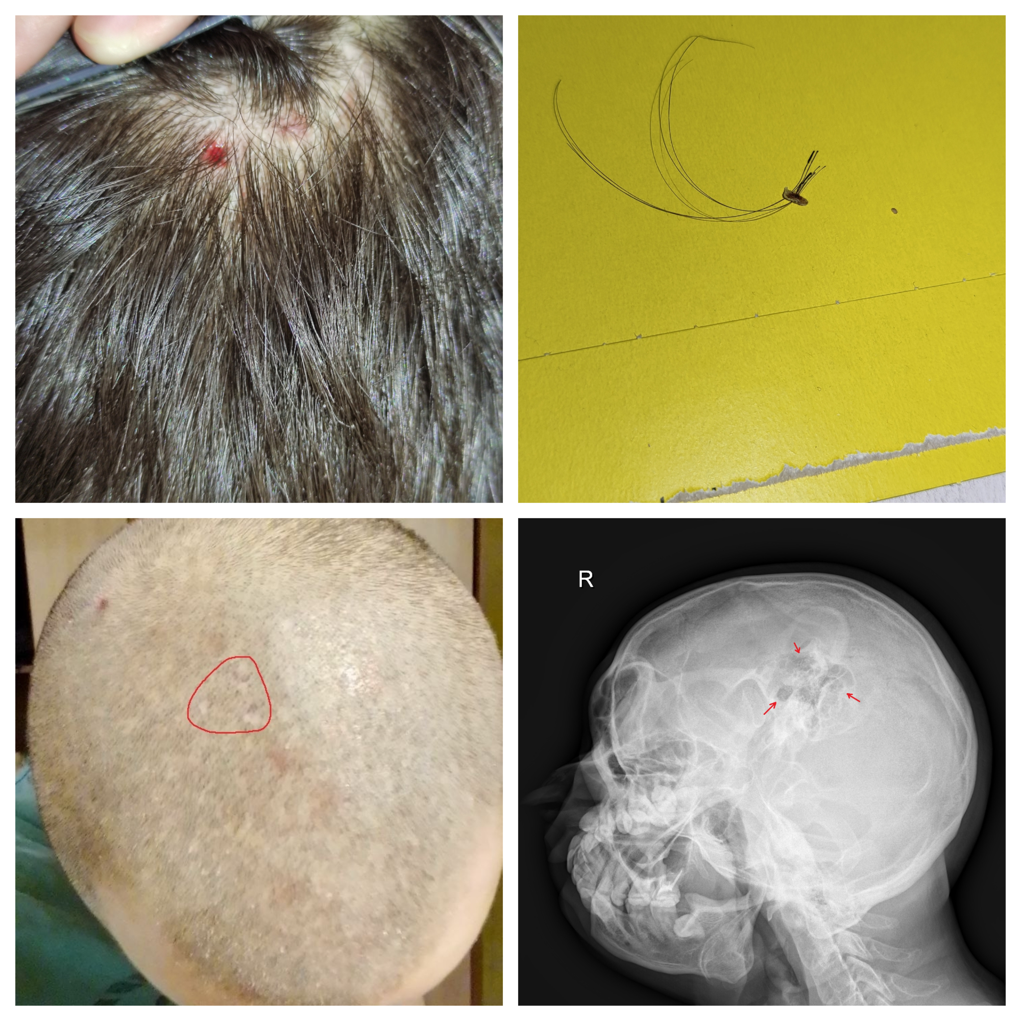 Fresh scars, then ingrown hairs, then healed scars, then marks on the skull